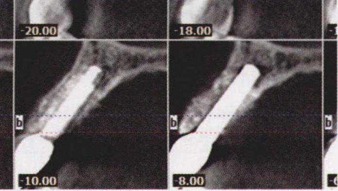 上颌前牙区根尖周囊肿处延期种植与美学修复